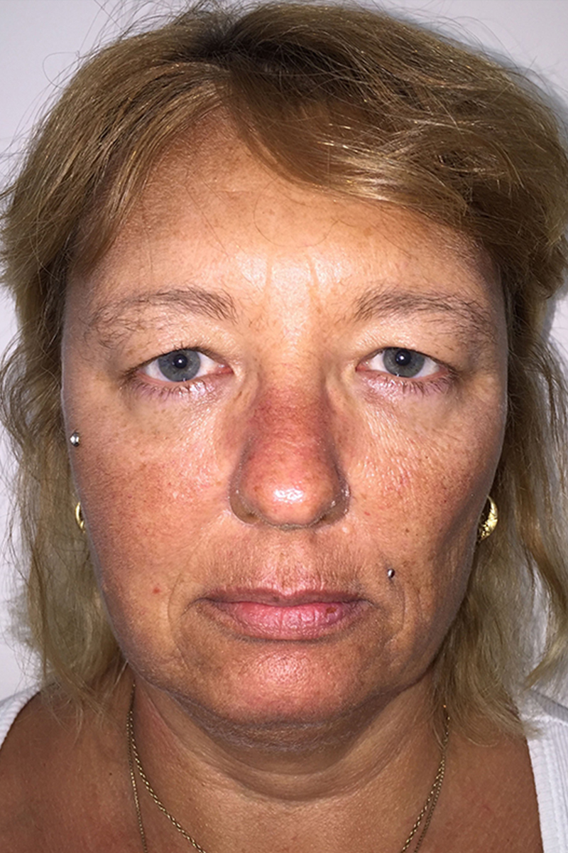 Before & After — before (pre-operative)